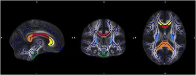 Mirror Movements in Amyotrophic Lateral Sclerosis: A Combined Study Using Diffusion Tensor Imaging and Transcranial Magnetic Stimulation